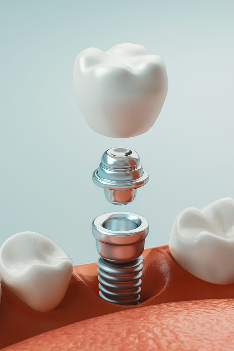 Ogv51 Implantes Fases